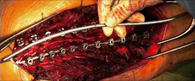 My spine was curved
at 63 degrees, - Molly's Game