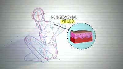 Natalie has a variant called
non-segmental vitiligo. - Naked Education