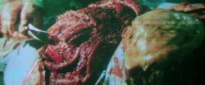 Now, Gabriel is conjoined
at the brain, - Malignant