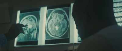 Now usually when there's a tumor
in this area, it's inside, - Synchronic
