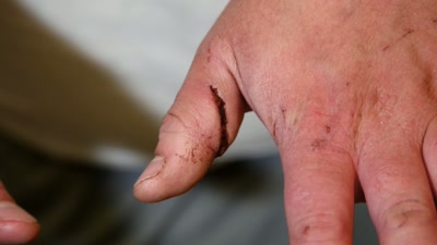 Obtaining a pretty serious wound
to his hand. - Killers: Caught on Camera