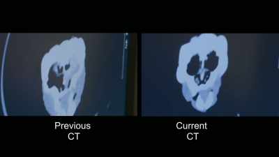 On ct, we can see instantly
that the sinus is nearly
completely clear. - Secrets of the Zoo