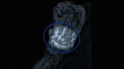 Probably the cartilage has
been lost and there's a - Pompeii: Secrets of the Dead