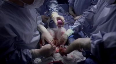 Removing cross clamp to
re-establish blood flow. - Grey's Anatomy