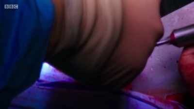 SAW BUZZES - Surgeons: At the Edge of Life