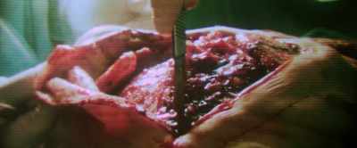 So Dr. Fields, Dr. Gregory,
and myself have concluded, - Malignant