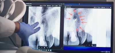 So we've got
a deep-pocket infection up top - Root Cause