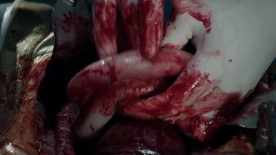 - Strangulated bowel's free.
- It looks to be perfusing well. - The Resident