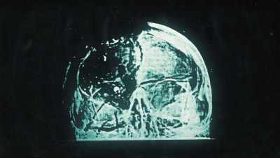 The back half of his right
cerebral hemisphere was gone. - JFK: What The Doctors Saw