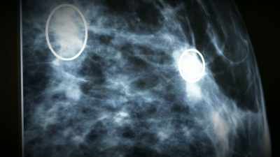 The computer has looked
at 1 billion mammograms, - Do You Trust this Computer?
