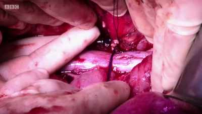 The deed is done. - Surgeons: At the Edge of Life