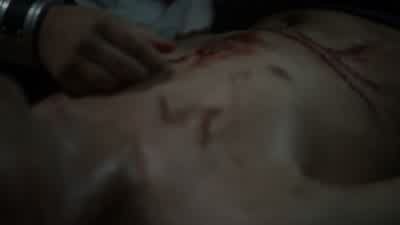 The grounders cauterized the wound. - The 100