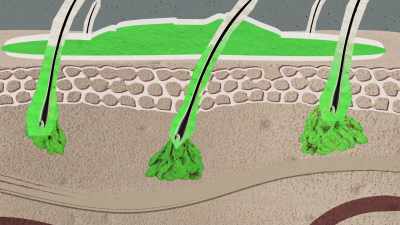 The hair
follicle openings - Not So Pretty