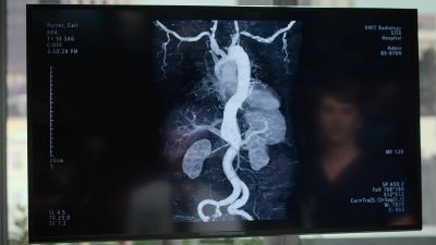 The liver is being
damaged by a new aneurysm. - The Good Doctor