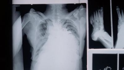 The mass appears on both
the right and left clavicle. - The X-Files