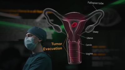 The tumor thinned
her uterine wall. - The Good Doctor