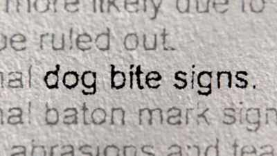 There are several areas
consistent with dog bites. - Killing County