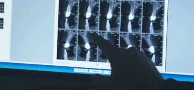 There's a cyst here
and there's a cyst here." - Root Cause