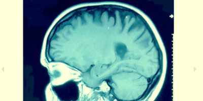 These tiny hemorrhages
in the brain tissue - The Fear Index