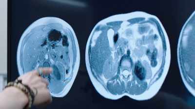 This is a T2 hyperintense, - The Resident
