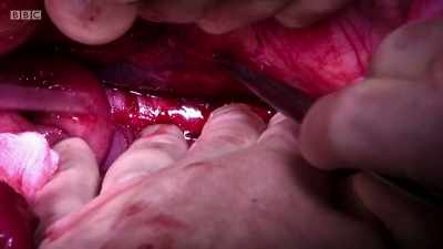 This is clearly monumental scale
surgery. - Surgeons: At the Edge of Life