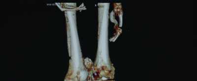 This fracture may
have been complicated, - Tutankhamun: Allies & Enemies