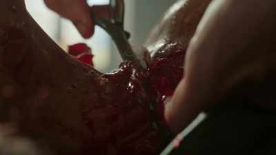 Using forceps
to slip the linen under the artery. - The Artful Dodger