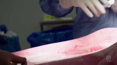 Using the patient's own cells, - Aussie Inventions That Changed The World