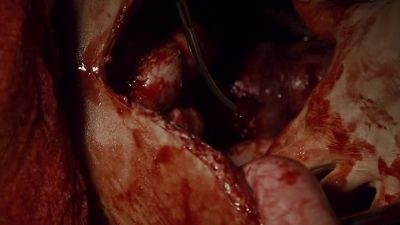 Was there damage to the spinal cord? - Murdoch Mysteries
