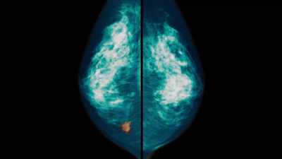 We heard many stories
around breast cancer, - Not So Pretty