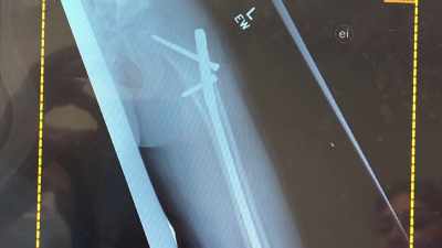 WELL, I HAD A SCREW THAT WAS
ALSO PLACED IN MY ANKLE. - Harlem Globetrotters: Play It Forward