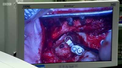 What I want is that hole in my incus - Surgeons: At the Edge of Life