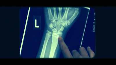 When a bone heals in a forearm, - The Real Prime Suspect