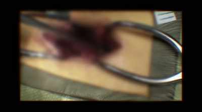 When I would touch those screws
and rods, they just moved, - Dr. Death: The Undoctored Story