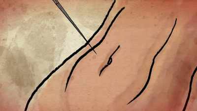 With a very long needle through
the belly button, - Extraordinary: The Seeding