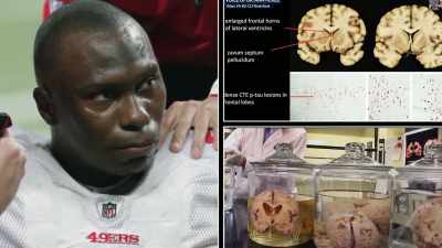 - WOMAN: Mr. Adams'
CTE pathology was different. - Impact x Nightline