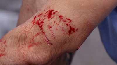 - Yeah, it looks like
a hematoma, which is a, - Kings of Pain