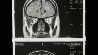 "You can see the scars
in the frontal lobe. - Crazy, Not Insane