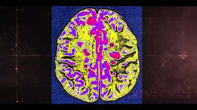 You get these random white
matter patches in the brain, - Beyond: UFOS and the Unknown