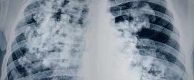 You'll see the mass
in the left lower lung field, - The Unholy