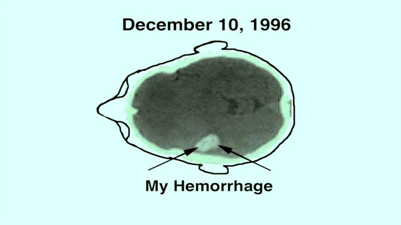A blood vessel exploded in the left half of my brain