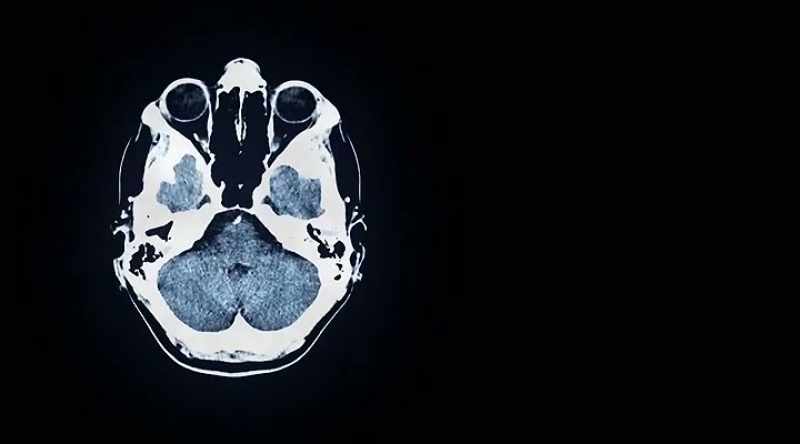 After multiple neurological tests