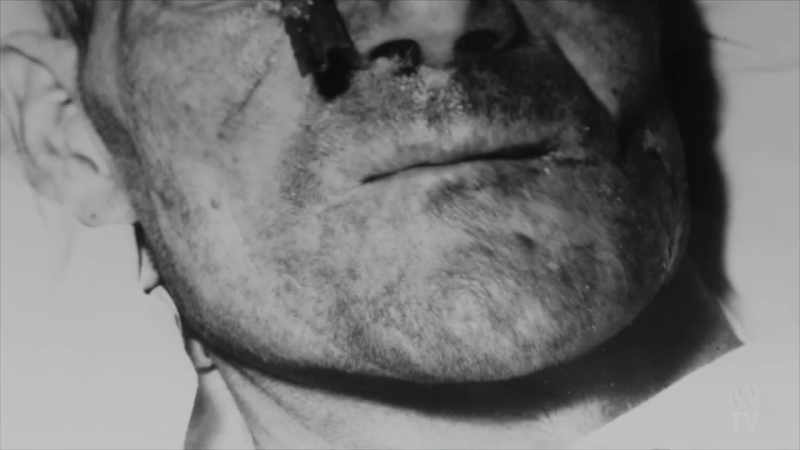 Albert Alexander was nearing death as infection spread