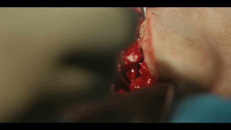 All right, it's out. There's the bone fragment