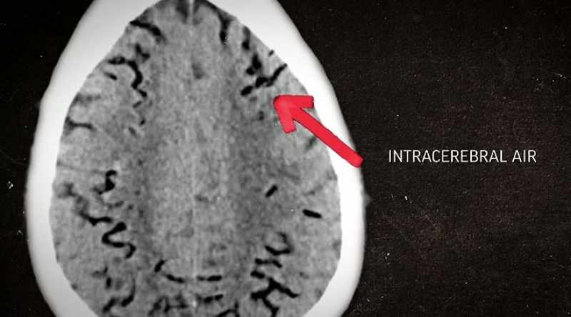 And it captured air in the brain