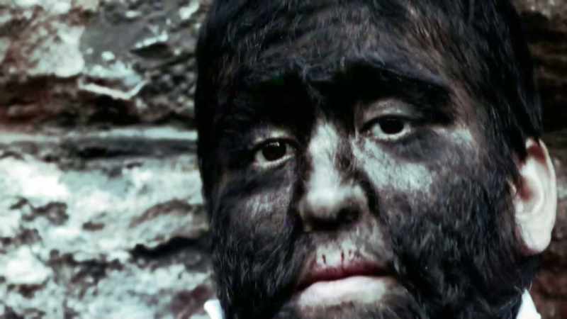 AND IT'S OFTEN KNOWN AS THE WEREWOLF SYNDROME
