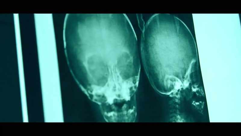 And so, I suggested that plain x-rays be taken
