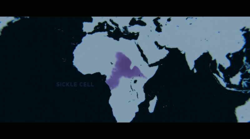 And that's why you see sickle cell anemia