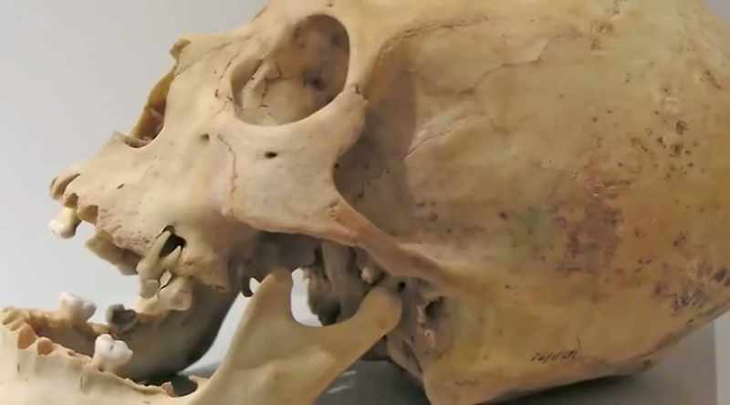 And they had many strange anatomic anomalies