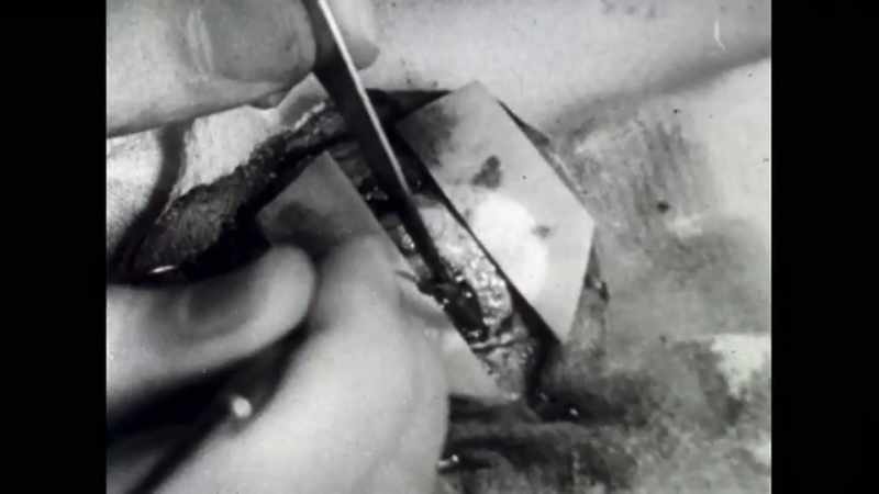And what they found after the operation was that the seizures